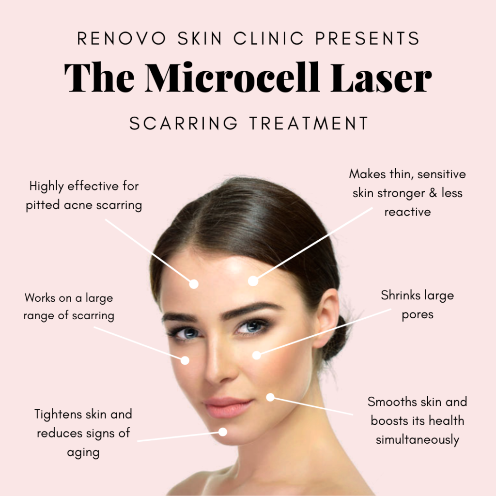 Acne Scarring | Renovo Skin Clinic