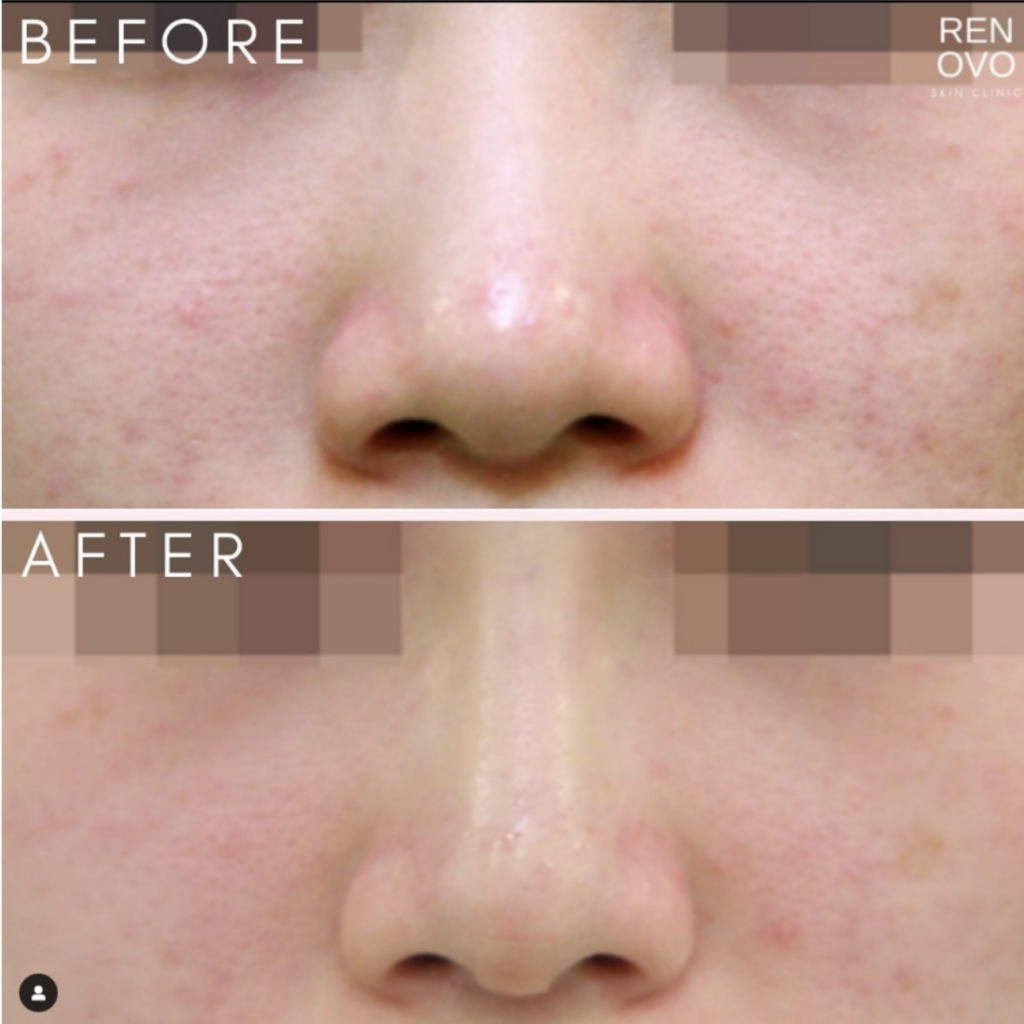 Thread Lifting in South Korea Renovo Skin Clinic